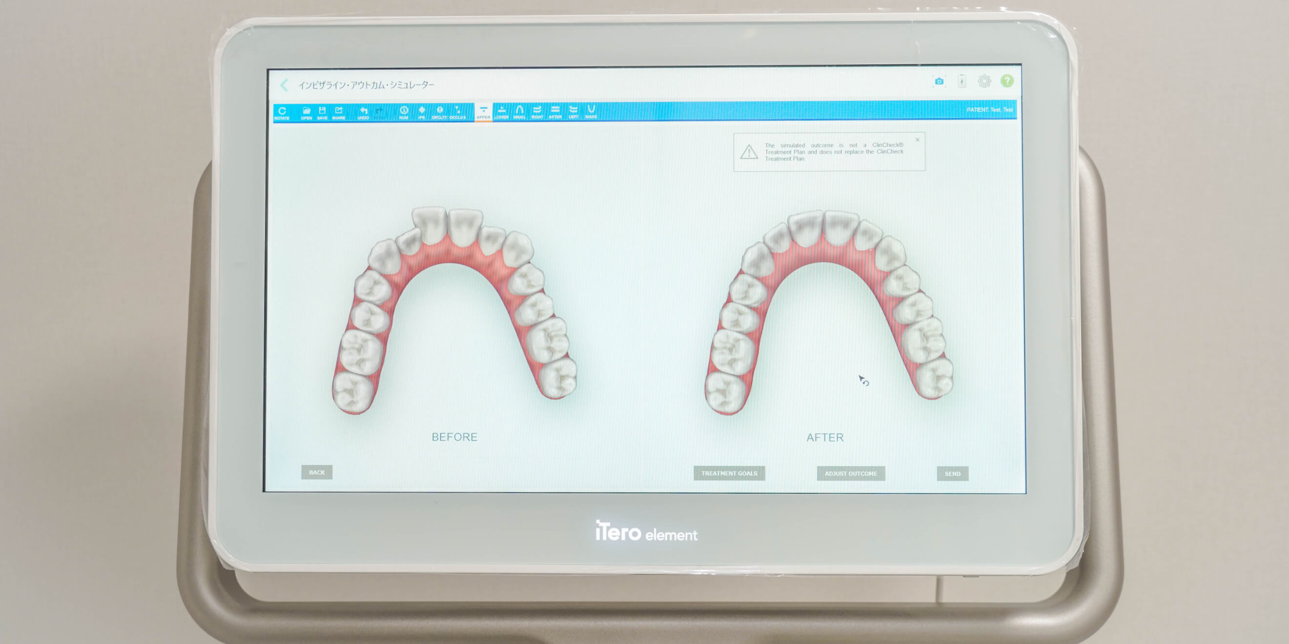 瞬時に矯正後の歯並びをシミュレーションで確認可能